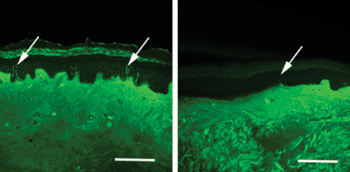 Image: These biopsy samples show significantly reduced density of nerve fibers (white arrows) in the skin of a fibromyalgia patient (right) compared with a healthy volunteer (left) (Photo courtesy of PAIN/doi/10.1016/j.pain.2013.06.001.)